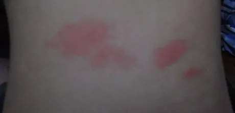 跳蚤咬的症状，被跳蚤咬了怎么办