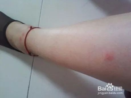 跳蚤咬的症状，被跳蚤咬了怎么办